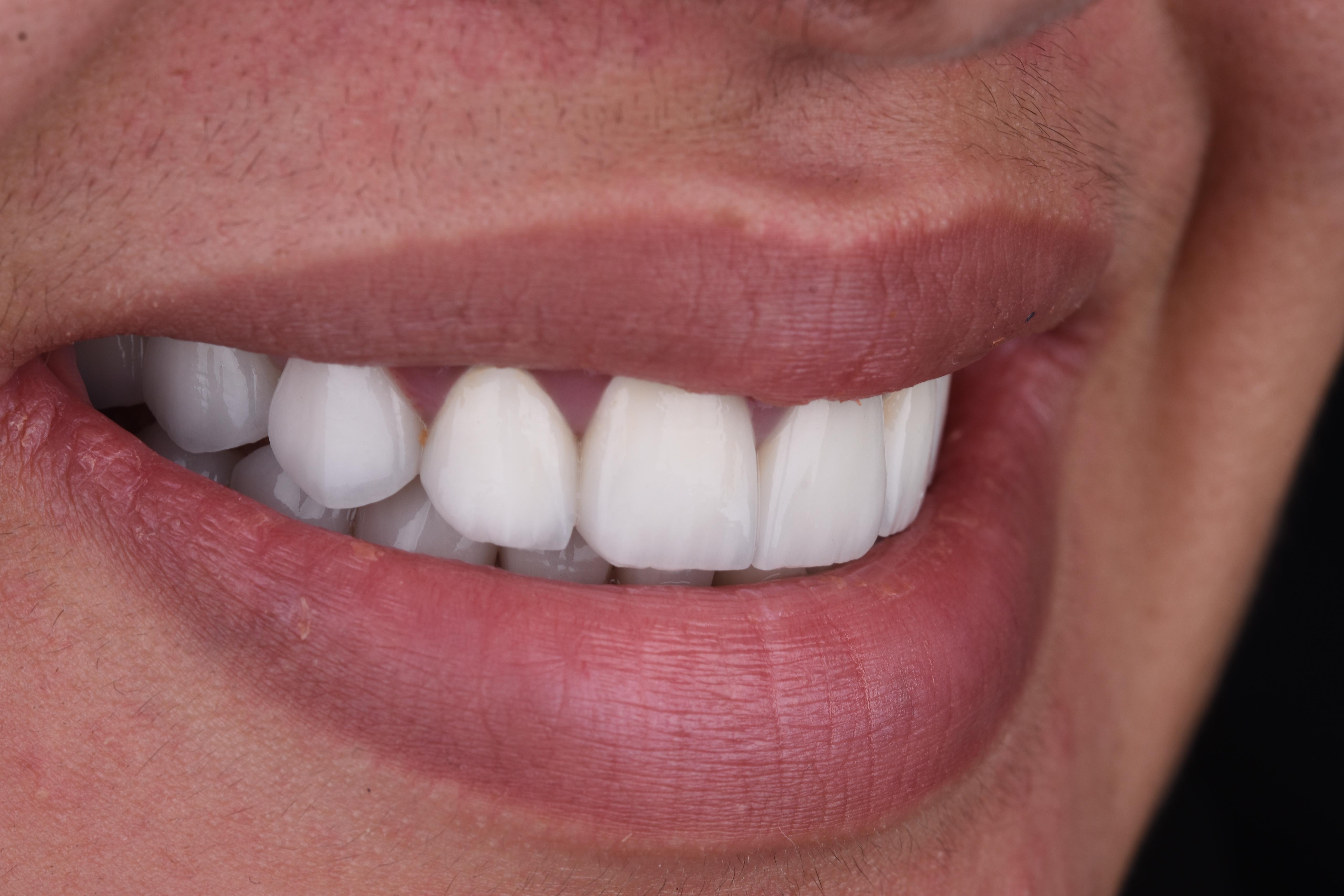 حالة معقدة - زراعة كاملة - بعد