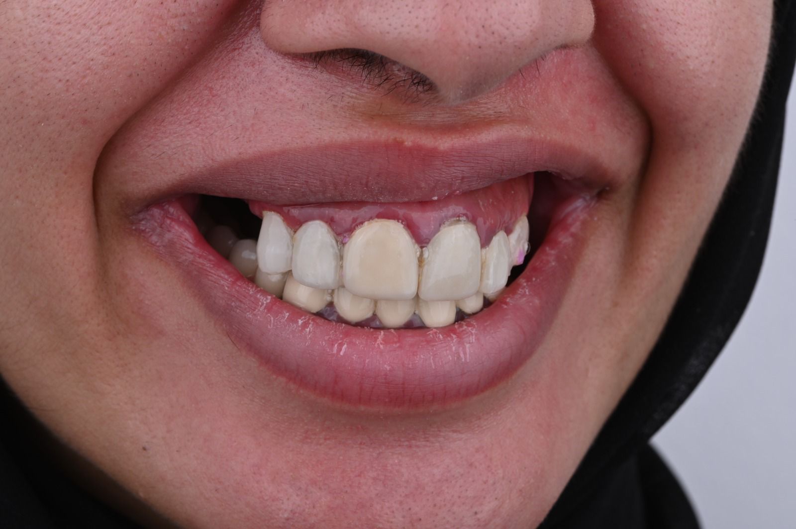 حالة معقدة - زراعة كاملة - قبل