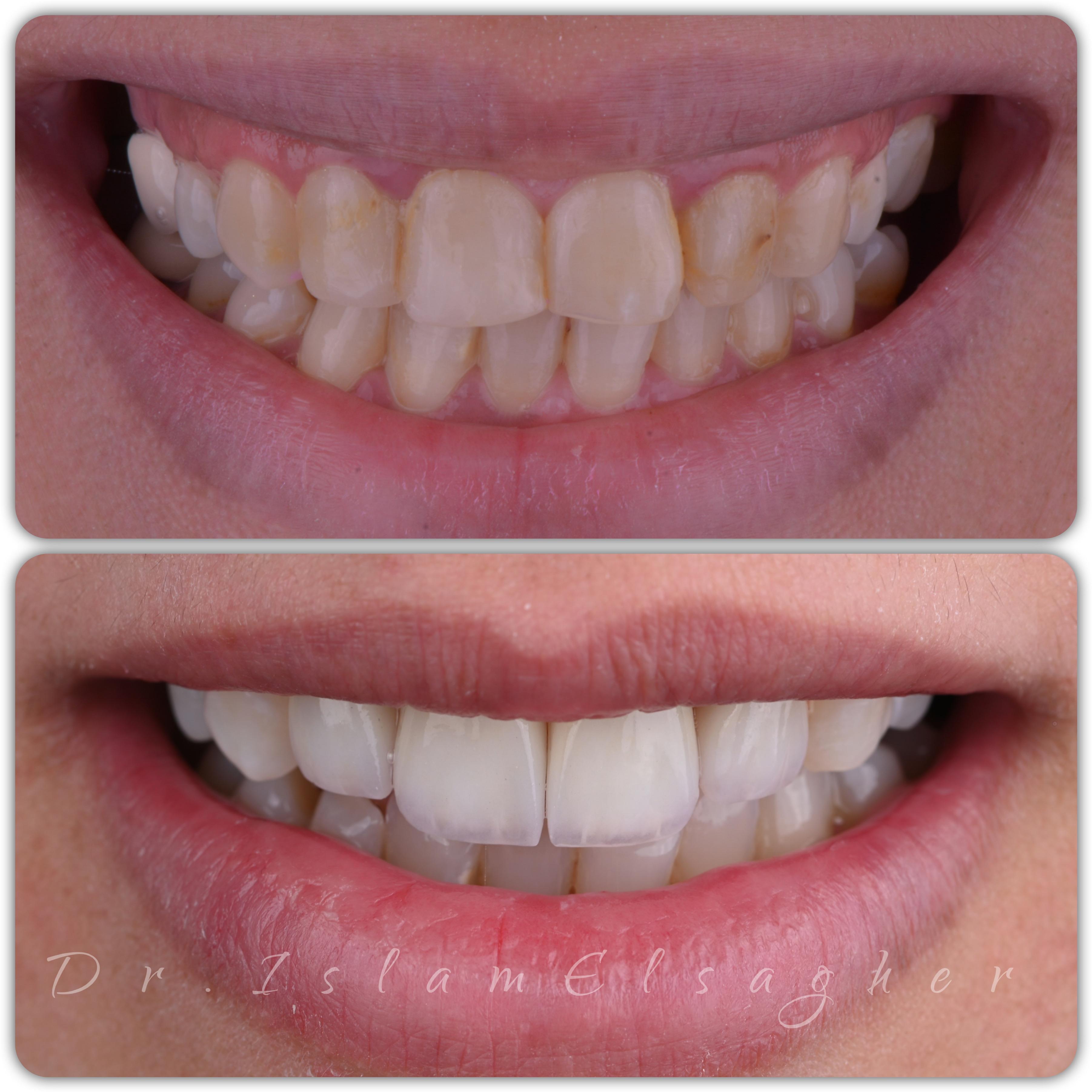 نتيجة جمالية طبيعية - بعد