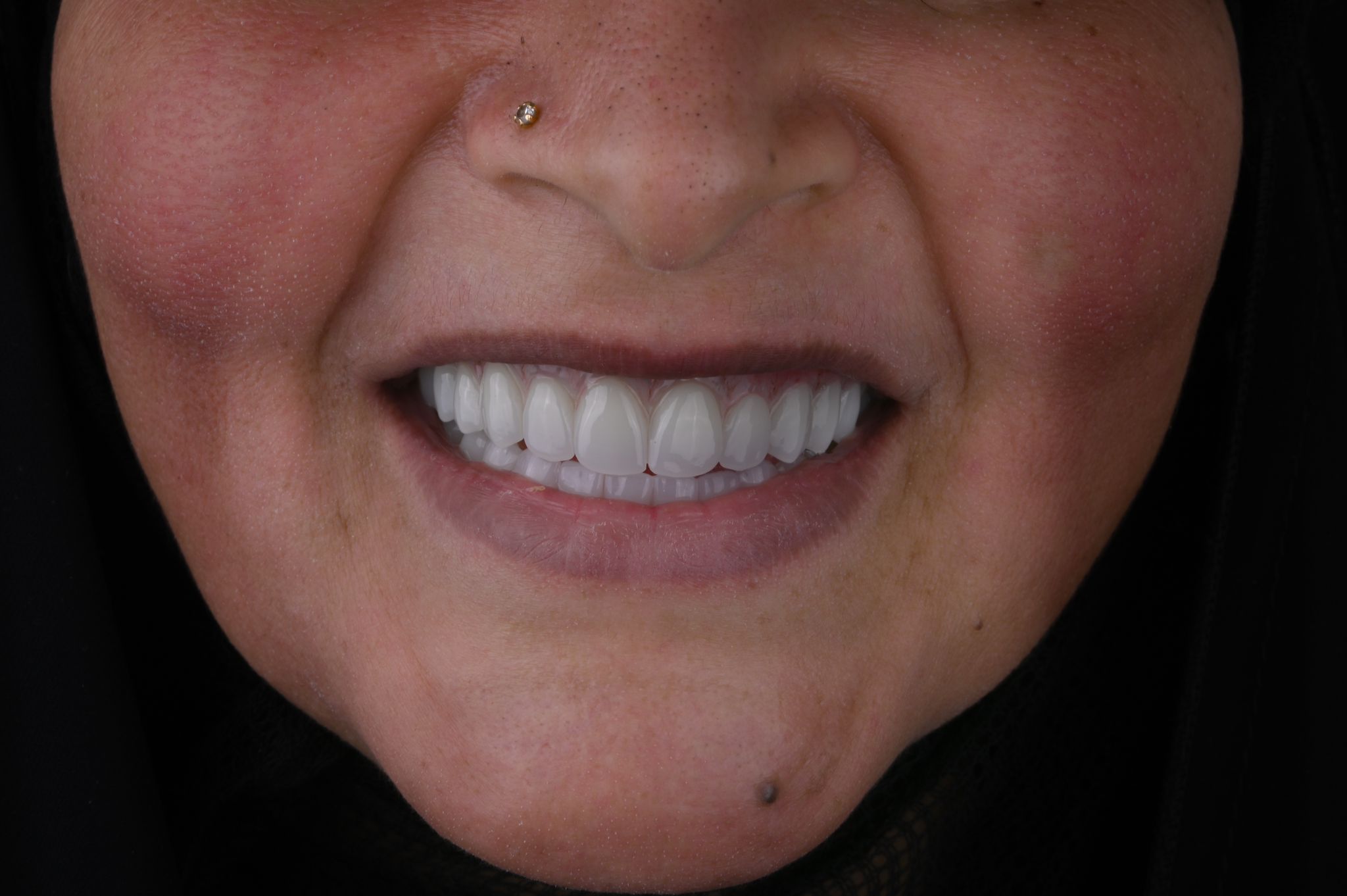 تحسين الابتسامة الأمامية - بعد