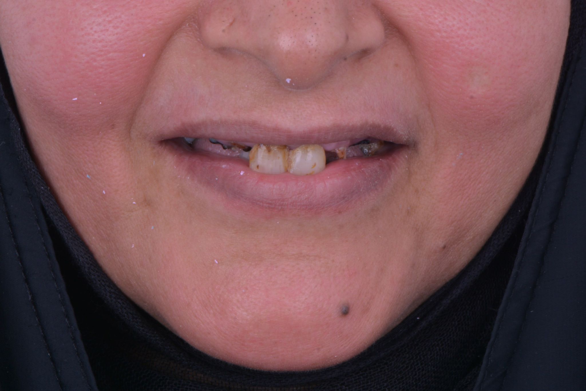 تحسين الابتسامة الأمامية - قبل