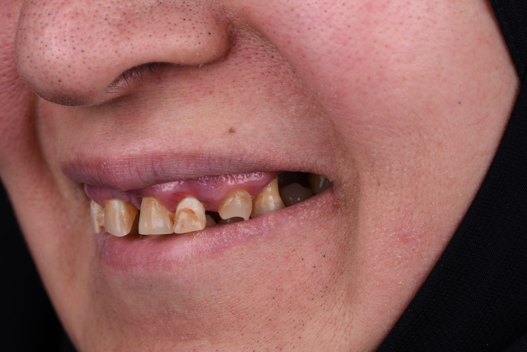 إعادة تأهيل كاملة للفم - قبل