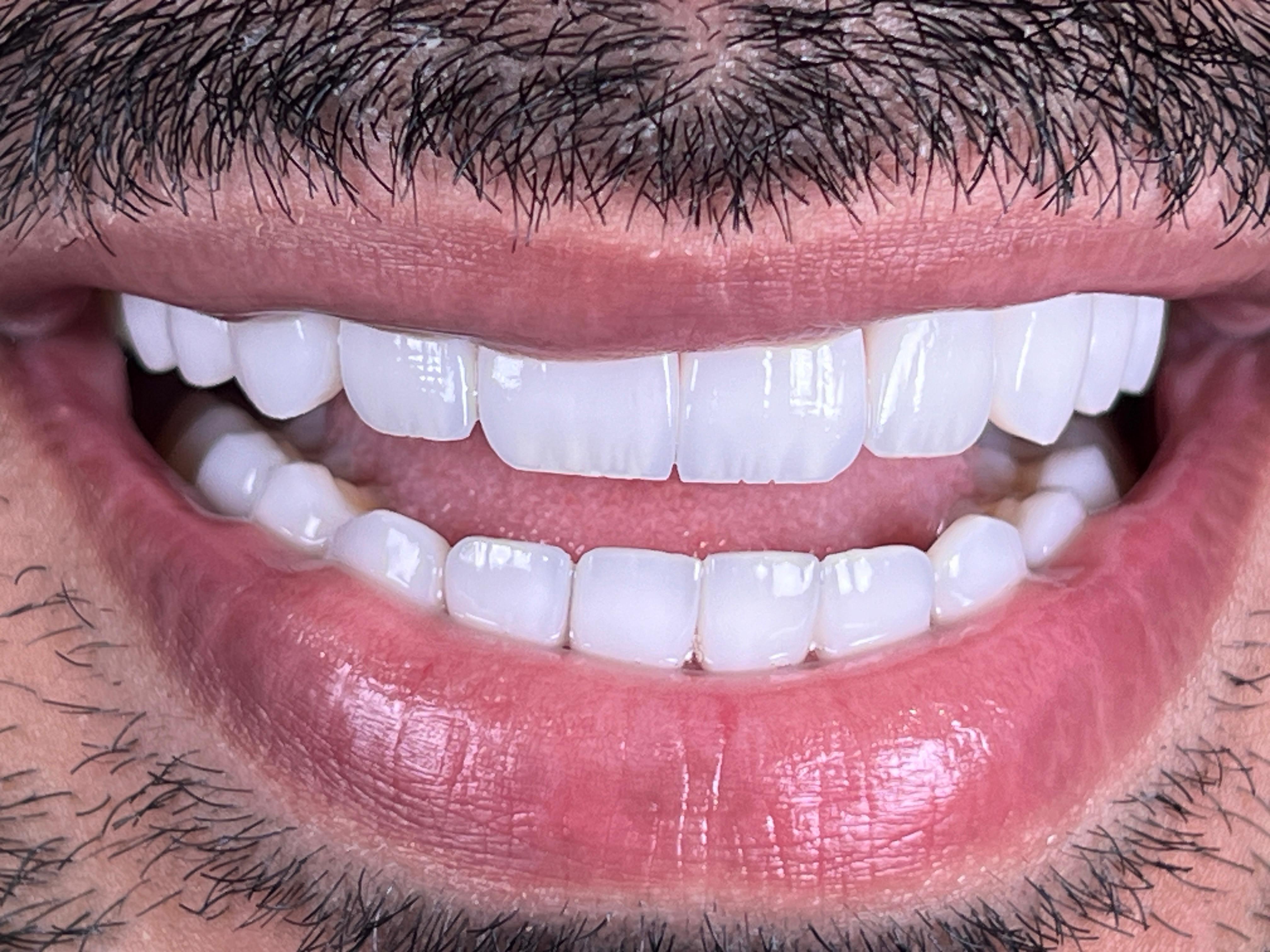 زراعة فورية مع تاج مؤقت - بعد