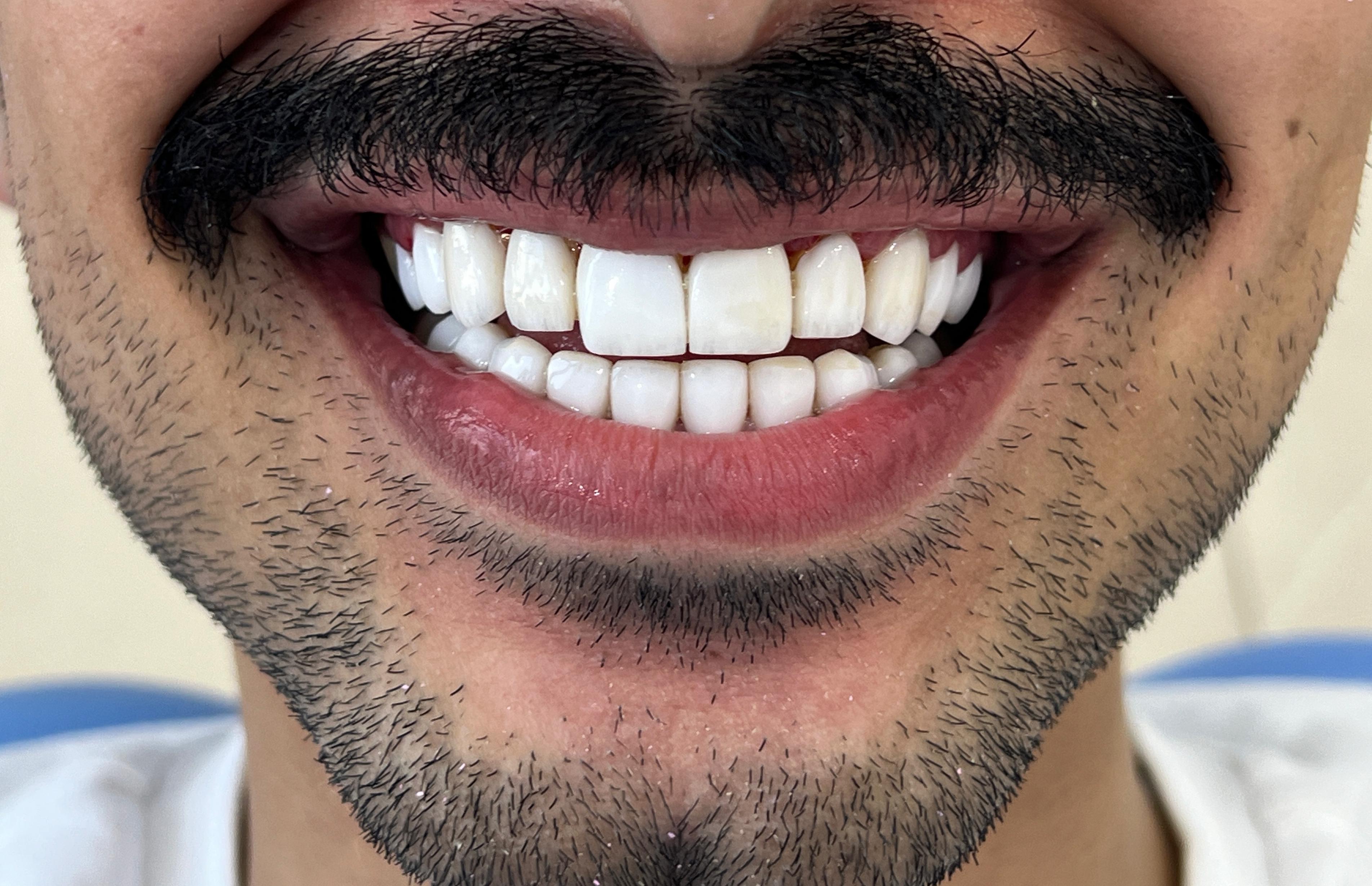 زراعة فورية مع تاج مؤقت - قبل